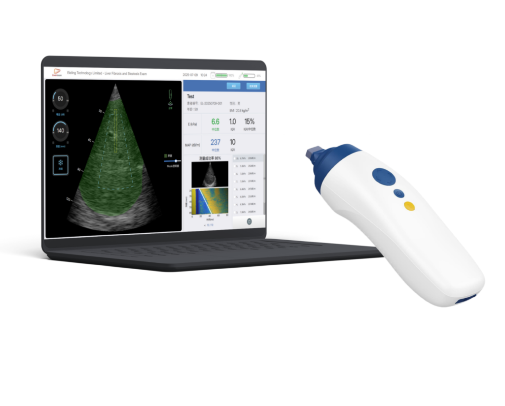 Liverscan Mobile wireless probe system for portable liver screening workflows